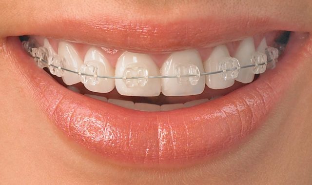 remboursement orthodontie