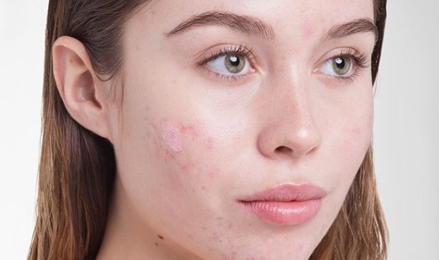 Comment se débarrasser de l'acné ?