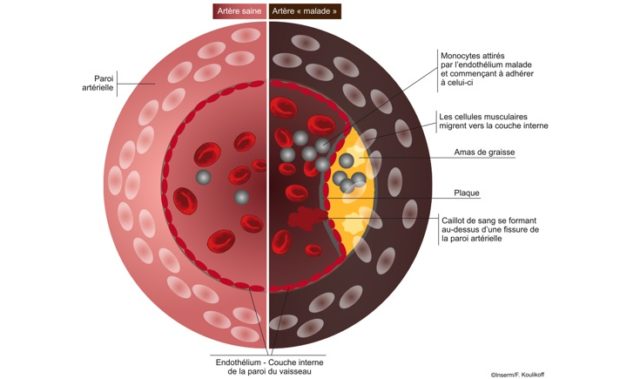 athérosclérose