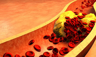 Cholestérol et maladies cardiovasculaires