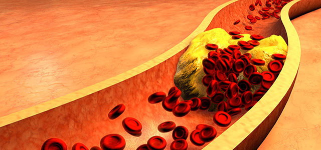 Cholestérol et maladies cardiovasculaires