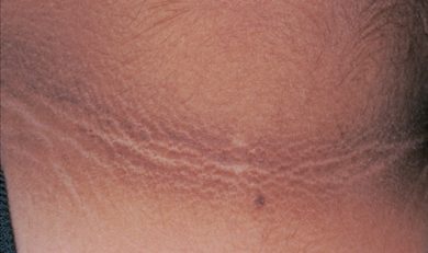 Acanthosis Nigricans