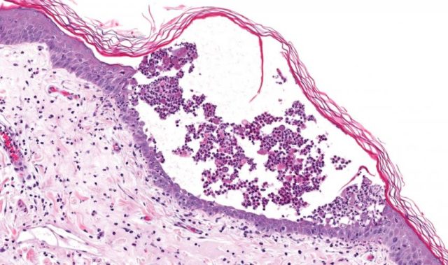 Pemphigus