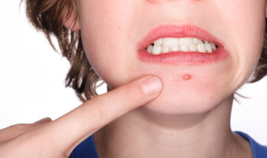 acne juvenile comment traiter