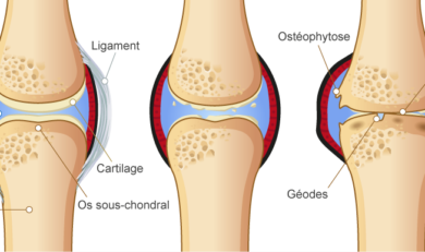 arthrose