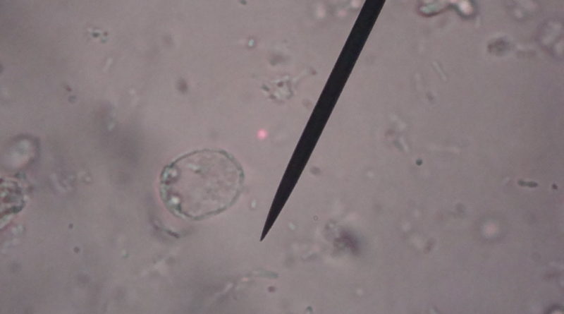 Blastocystis Hominis