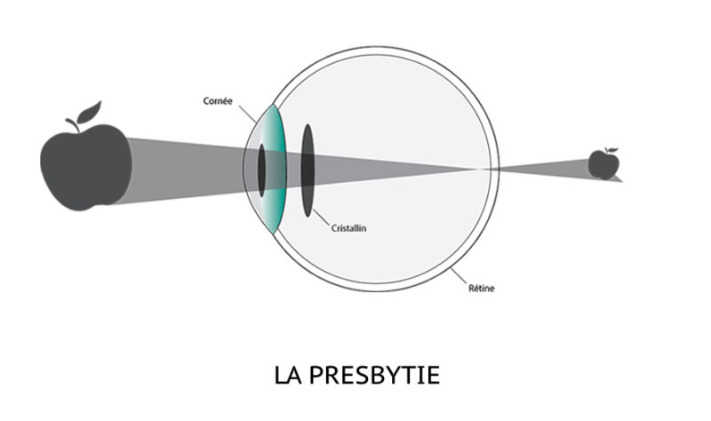 Qu'est ce que la Presbytie ? Yeux et vision