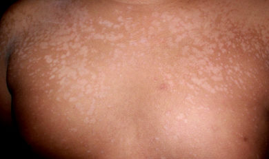 pityriasis