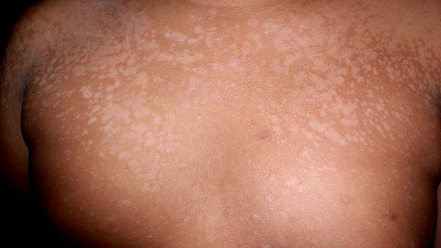 pityriasis