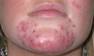 Pustules