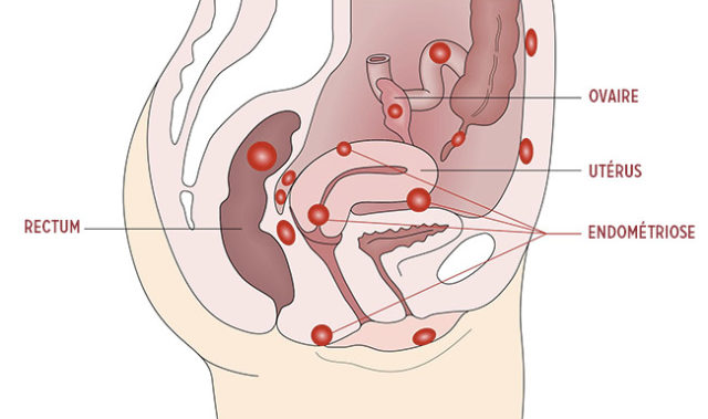 endometriose