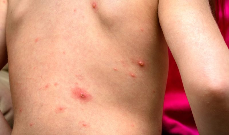 Qu'est ce qu'un zona ? - Maladies de peau