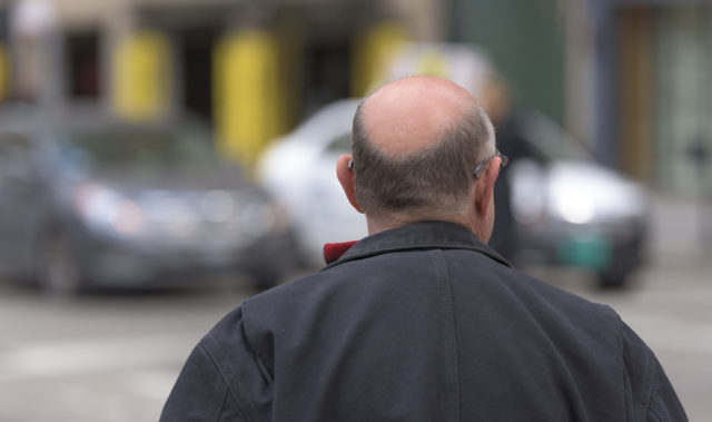 greffe de cheveux