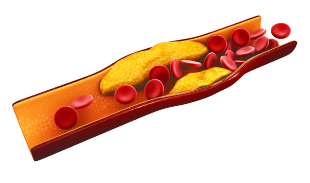 thrombose veineuse