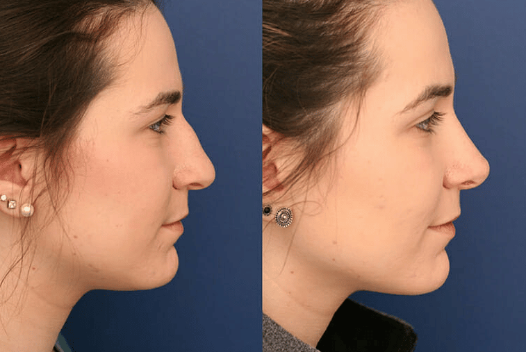 chirurgie du nez